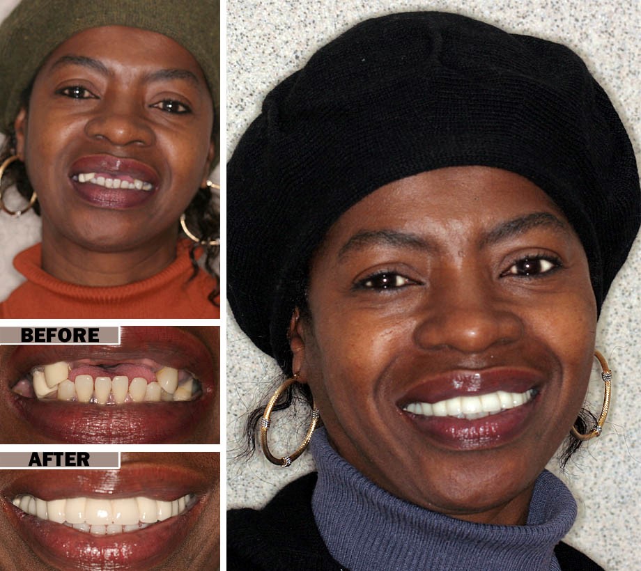 Upper Dentures Before And After Pictures San Francisco CA 94122